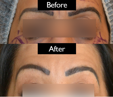 brow-patient4